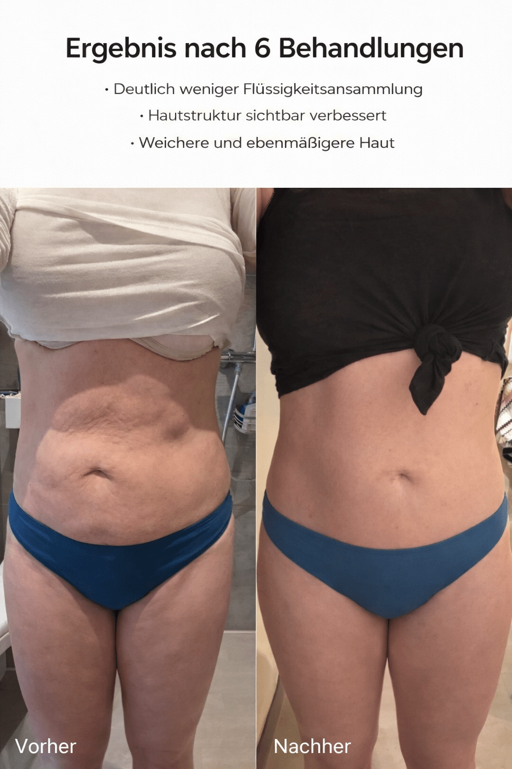 Celluviaa – Cellulite - Behandlung - Celluviaa.com